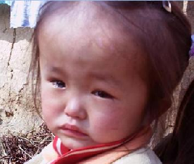 脑积水是咋回事呢?去哪家医院治疗脑积水效果